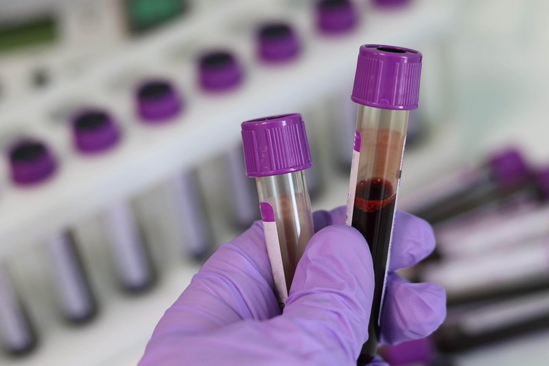'Ferritin face' trend: doctors say only a blood test shows low iron