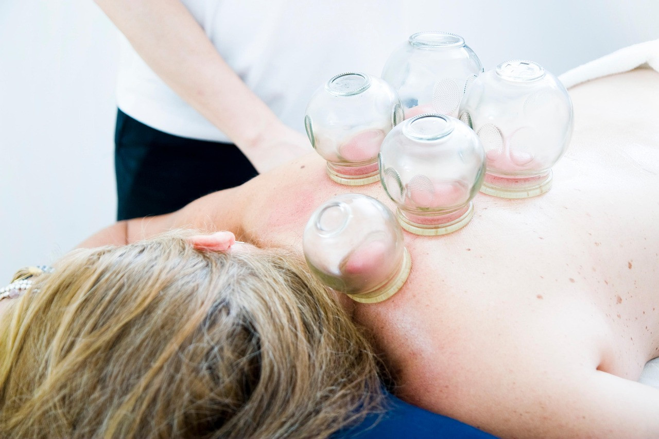 Representative image: cupping therapy